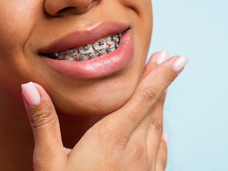 Featured image for “What Kind of Braces Are Right for Me?”